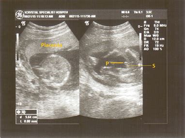 does a 39 week gestation male's testes drop in scrotum|undescended testicles in baby.